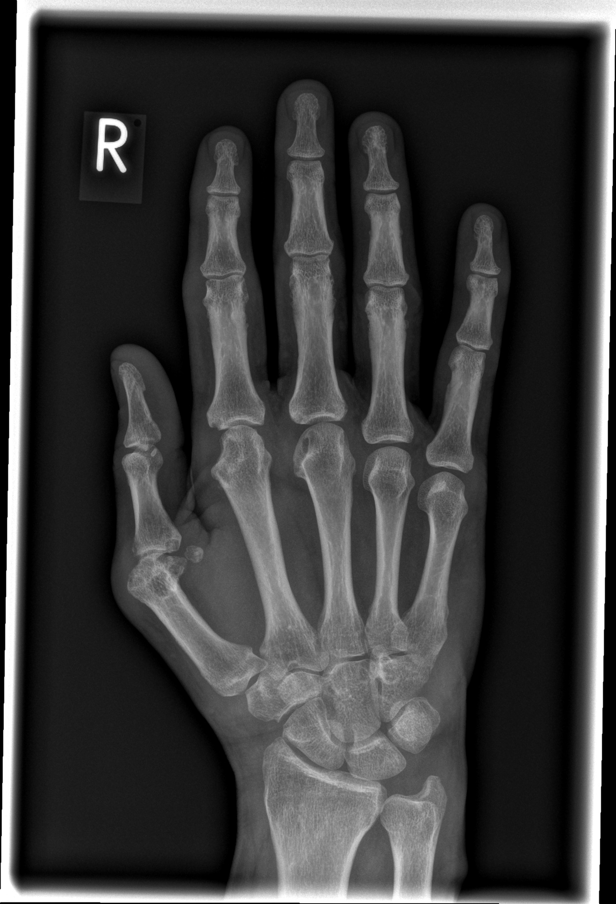 Swelling of the PIP joints and wrist BERLINCASEVIEWER